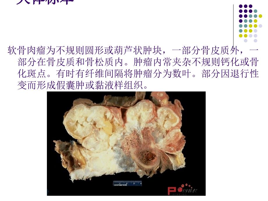 软骨肉瘤病理及影像学表现_第1页