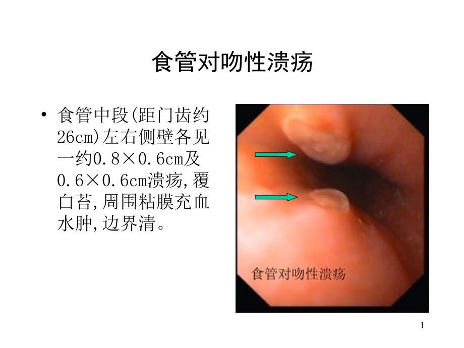 典型内镜图片参考课件_第1页