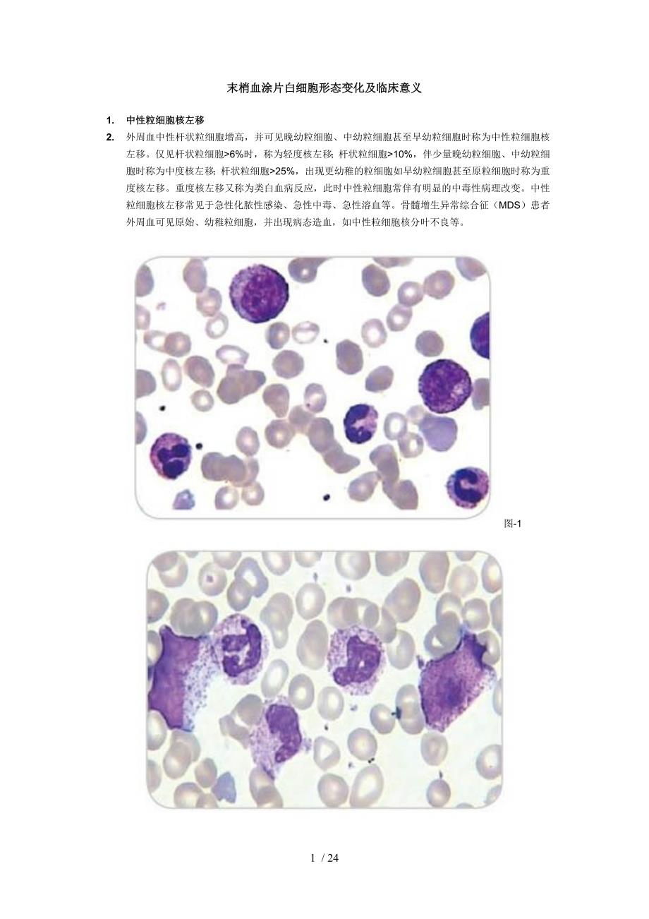 末梢血涂片白细胞形态变化及临床意义参考_第1页