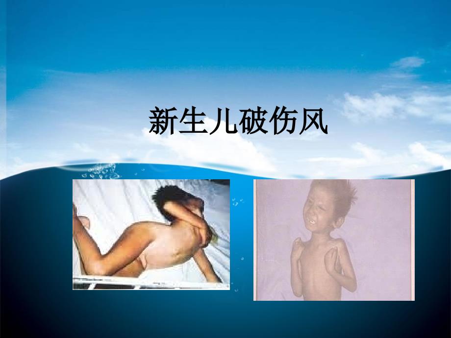 新生儿破伤风素材课件_第1页