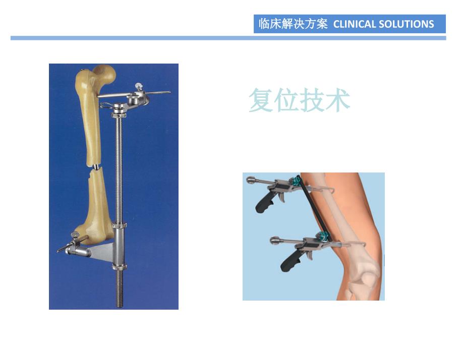 骨科基础-复位技术_第1页