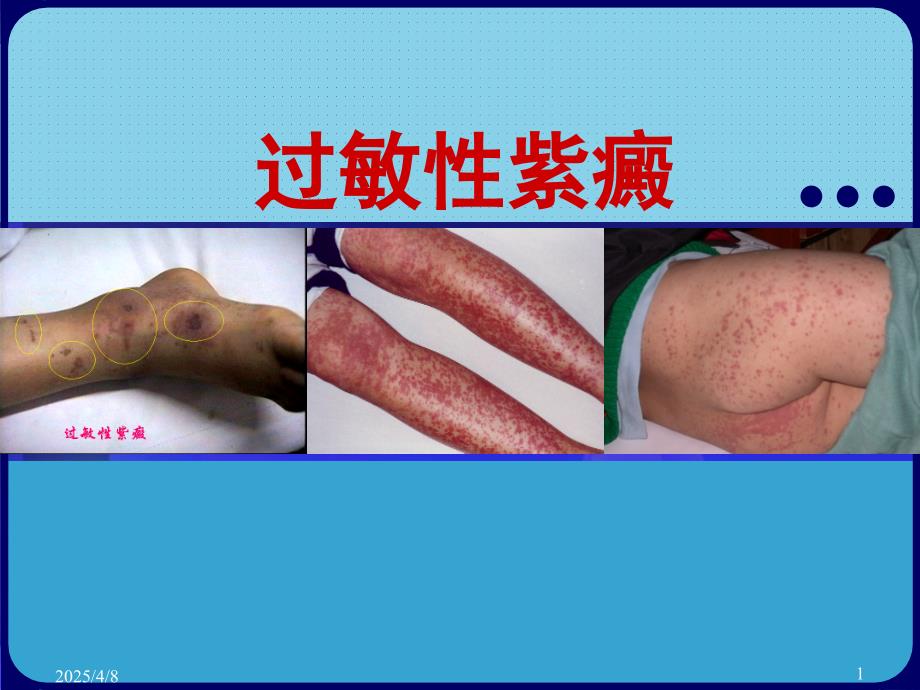 儿科课件：过敏性紫癜_第1页